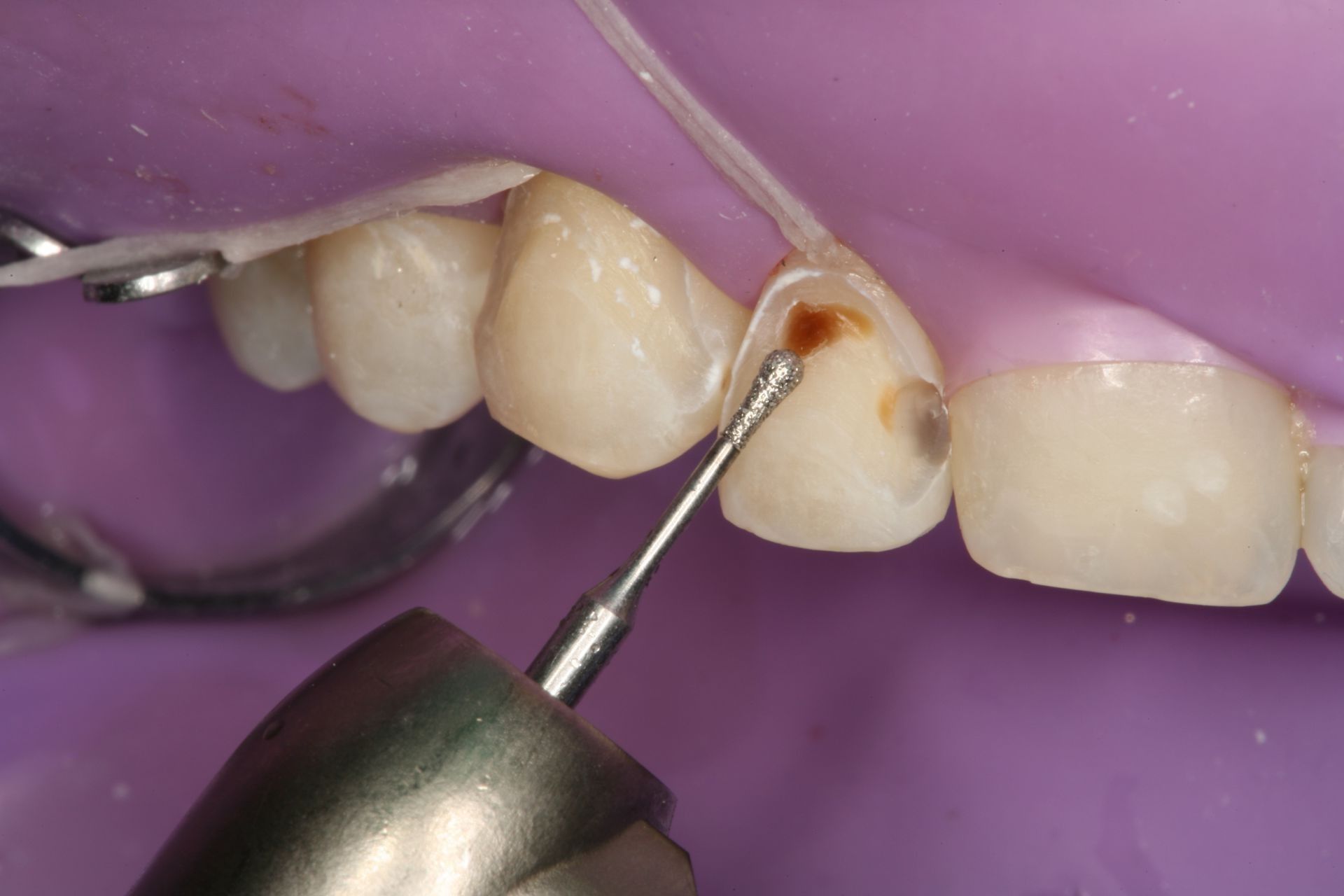 Bounce Back! Are Dentists Using Rubber Dam Isolation in Practice?