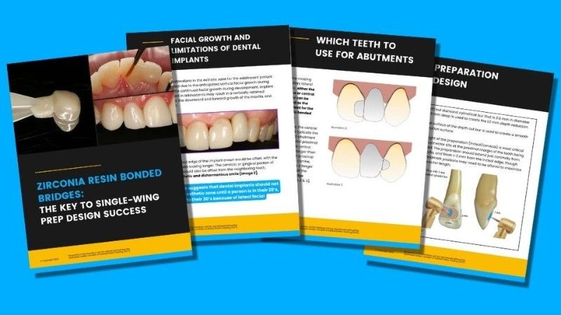 Zirconia Resin Bonded Bridges The Key To Single Wing Prep Design Success