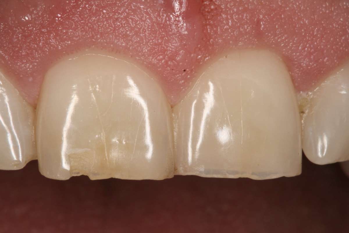 Maxillary lateral incisor with cracks (labial view). (a) Craze lines on