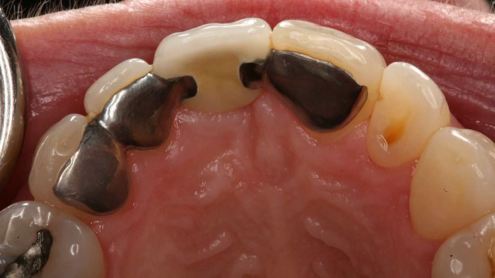 How to create a Direct Resin Bonded Bridge 