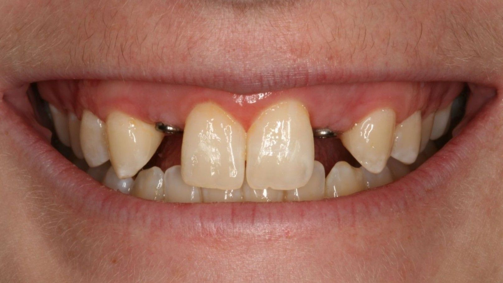 Zirconia Bridge Technique  Conservative Esthetic Tooth Replacement