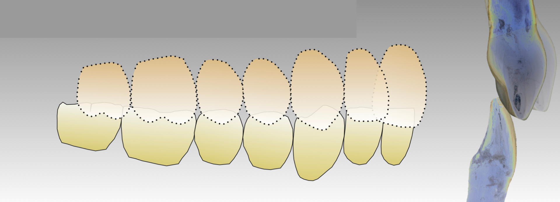 TMD: Class II Division 1 and 2 Type Problems: Over Closed Bites – Occlusion  Connections