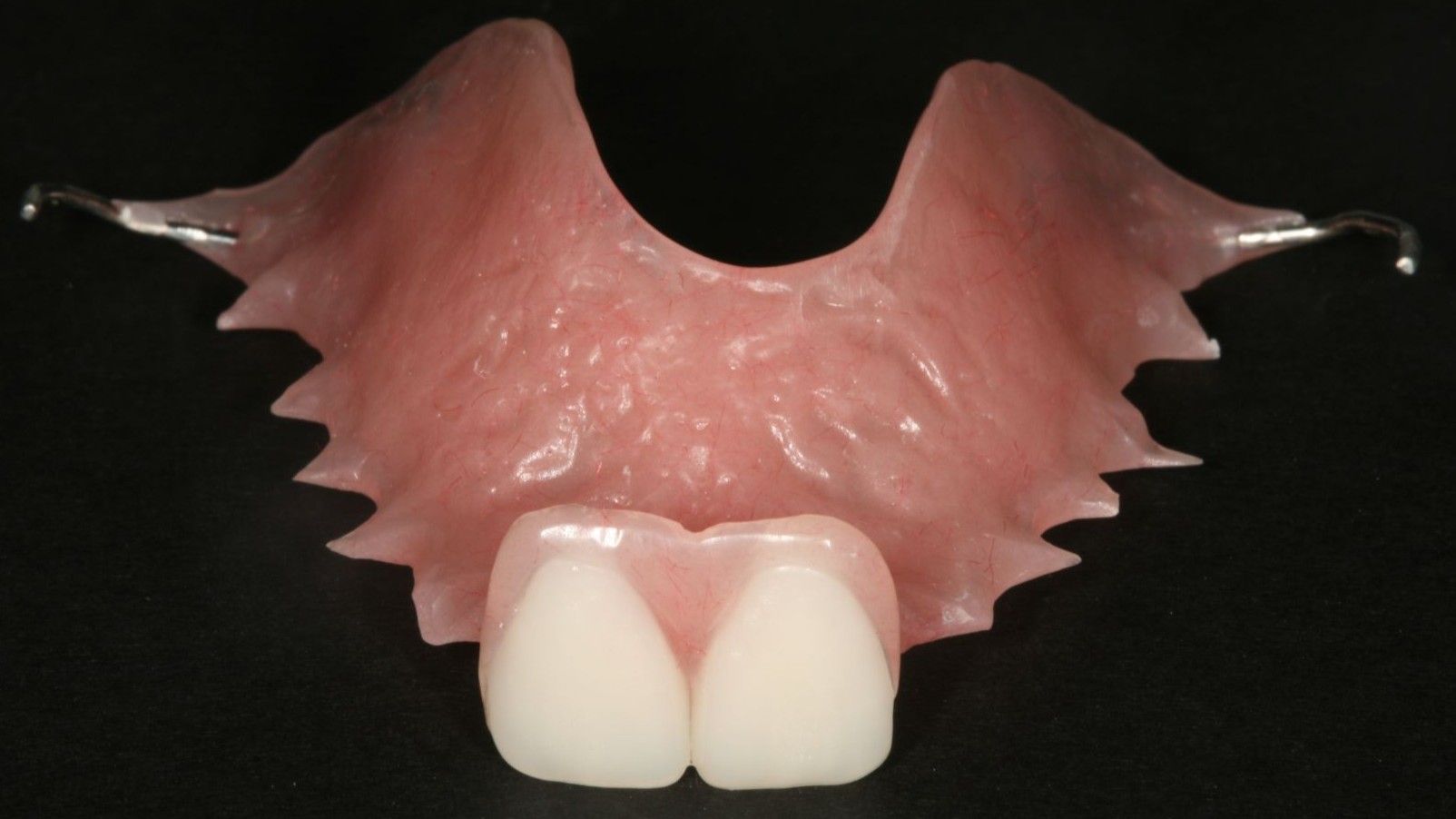 Resin Bonded Bridge: Minimally Invasive Option for Tooth Replacement - Shor  Dental