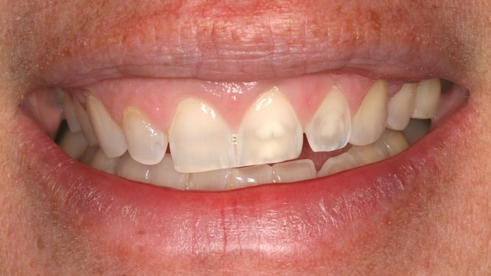 Canted Smile Guide: 7 Reasons for the Unaesthetic Canted Smile and