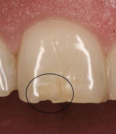 How To Classify the 5 Types of Cracked Teeth - Spear Education