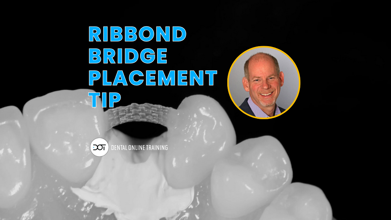 Advanced Ribbond Bridge Placement Technique for Better Bonding Results